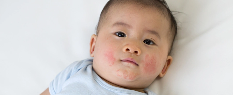 Banner Artikel 13 Jenis Gatal pada Kulit Bayi: Penyebab, Gejala, dan Cara Mengatasinya